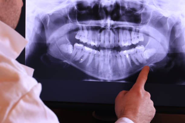 Best Emergency Dentist for Lost Fillings or Crowns in Concordia, NJ